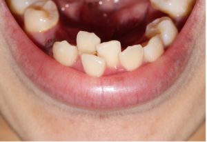 orthodontic crowing in children