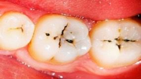 Close-up image showing molar pit and fissure cavities with dark spots on the teeth