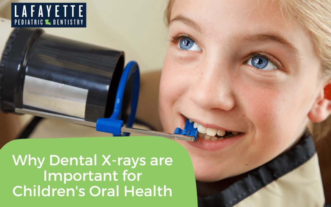 Why Dental X-rays are Important for Children’s Oral Health