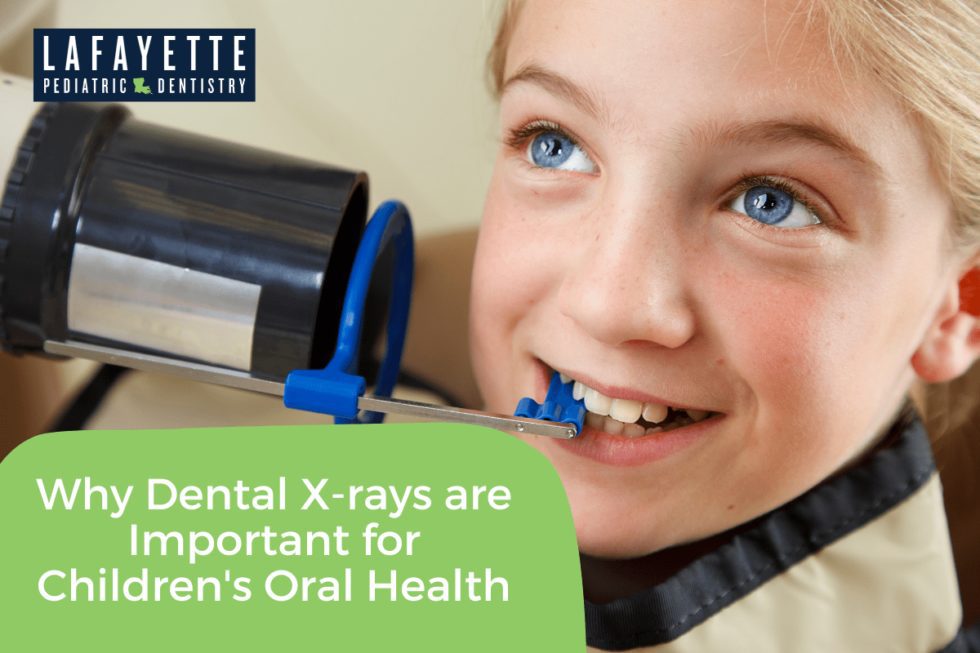 Why Dental Xrays are Important for Children's Oral Health Lafayette
