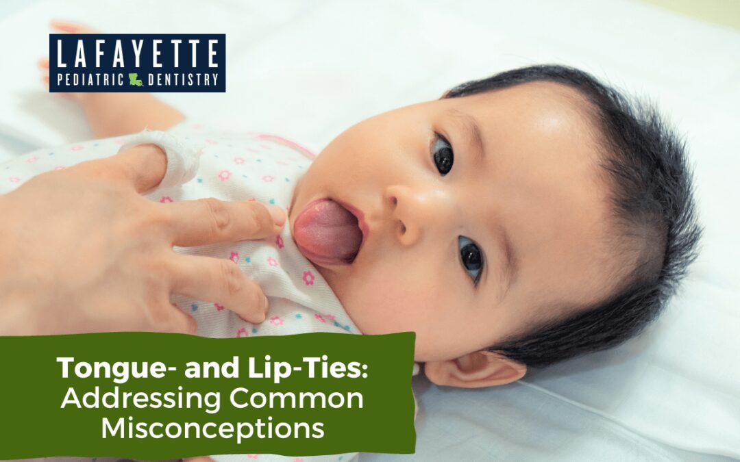 Tongue- and Lip-Ties: Addressing Common Misconceptions
