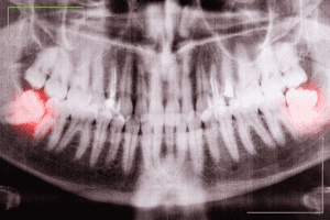 An X-ray or radiograph of a person's jaw and teeth. The teeth are blurry but visible, with the wisdom teeth highlighted by red circles on both sides of the jaw.