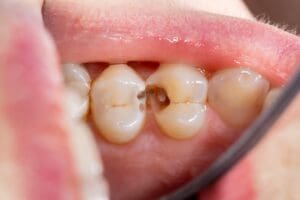 Close-up image showing cavities between a child's teeth