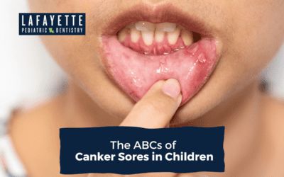 The ABCs of Canker Sores in Children