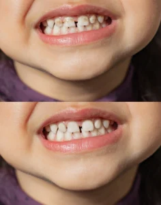 Close-up comparison of a child's teeth with visible iron staining in the top image, showing brownish discoloration on the teeth, and the same teeth appearing clean and white in the bottom image after the iron staining has been removed.