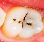 Close-up of a tooth with visible dental caries. The tooth surface shows dark spots indicating decay.