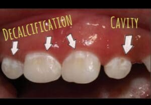 Close-up of upper teeth showing dental issues. Three arrows point to areas of decalcification on the front teeth, and one arrow indicates a cavity on a canine