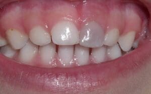 Close-up of teeth showing signs of dental trauma. The upper right central incisor appears discolored, indicating possible damage.