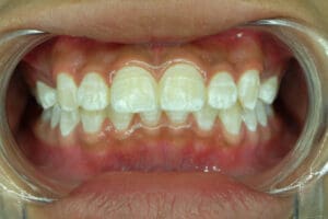 Close-up of teeth with a dental retractor holding the mouth open. Multiple teeth, especially the upper front teeth, show white spots and streaks characteristic of dental fluorosis.