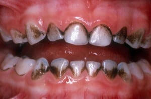 Close-up of teeth showing significant dark staining, particularly around the edges and between teeth, due to iron supplement use.