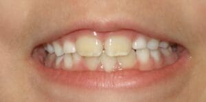 Close-up of a child's smile, showing teeth with slight discoloration or yellowing on the front two upper teeth.