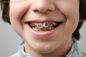 A close-up of a smiling child wearing metal braces with red and black brackets on their teeth