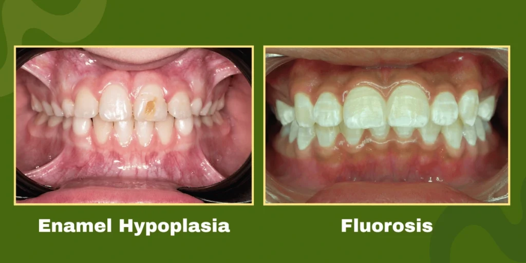 Comparison image of two dental conditions: on the left, enamel hypoplasia showing a discolored front tooth; on the right, dental fluorosis with white streaks and spots on multiple teeth