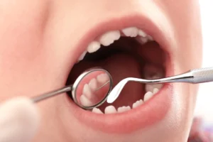 Close-up of a child’s open mouth during a dental exam, showing small ridges on the edges of the front teeth, examined with dental mirror