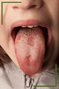Close-up of a child’s open mouth with their tongue extended, showing smooth, irregular red patches with white borders consistent with geographic tongue.